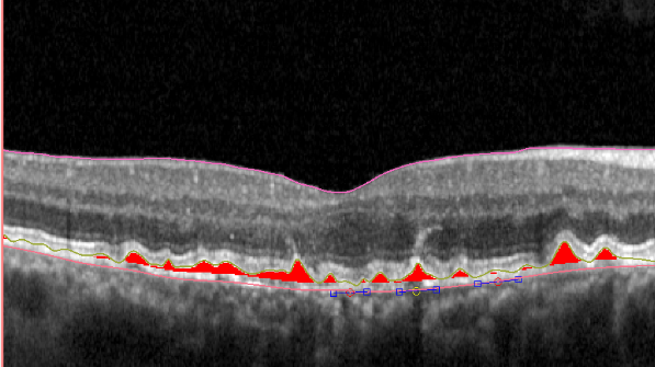 Retinal layer segmentation in OCT imaging.